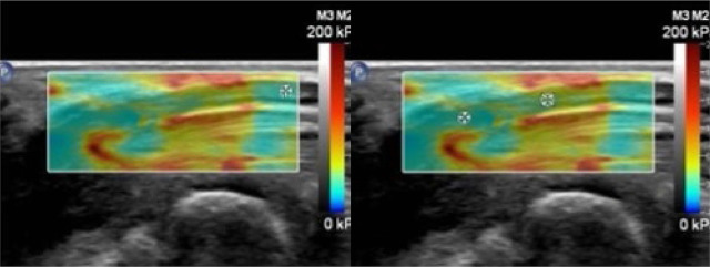 Elastografia tempo formacion 1.jpg